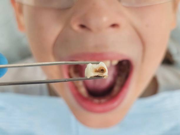 Best Emergency Dental Care for Broken or Chipped Teeth in Atkins, VA